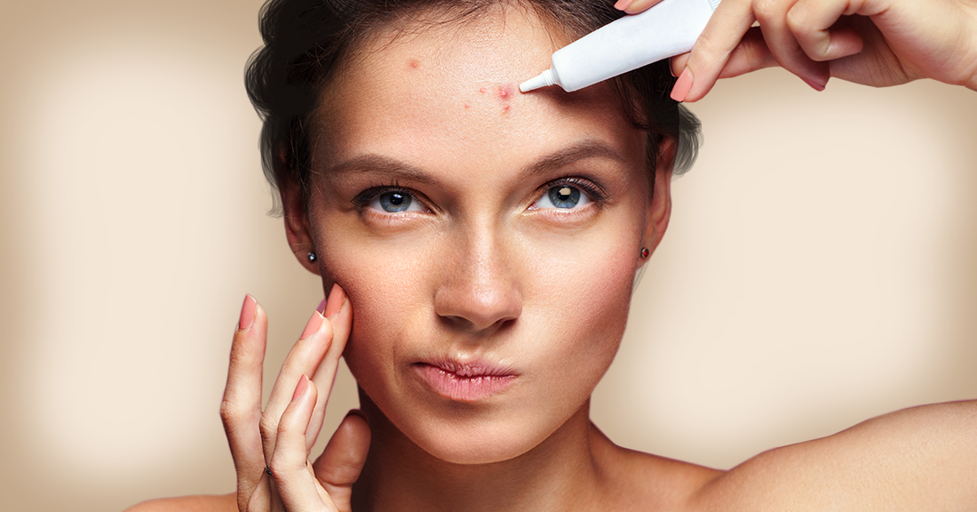 Types of Acne and How To Deal With Them