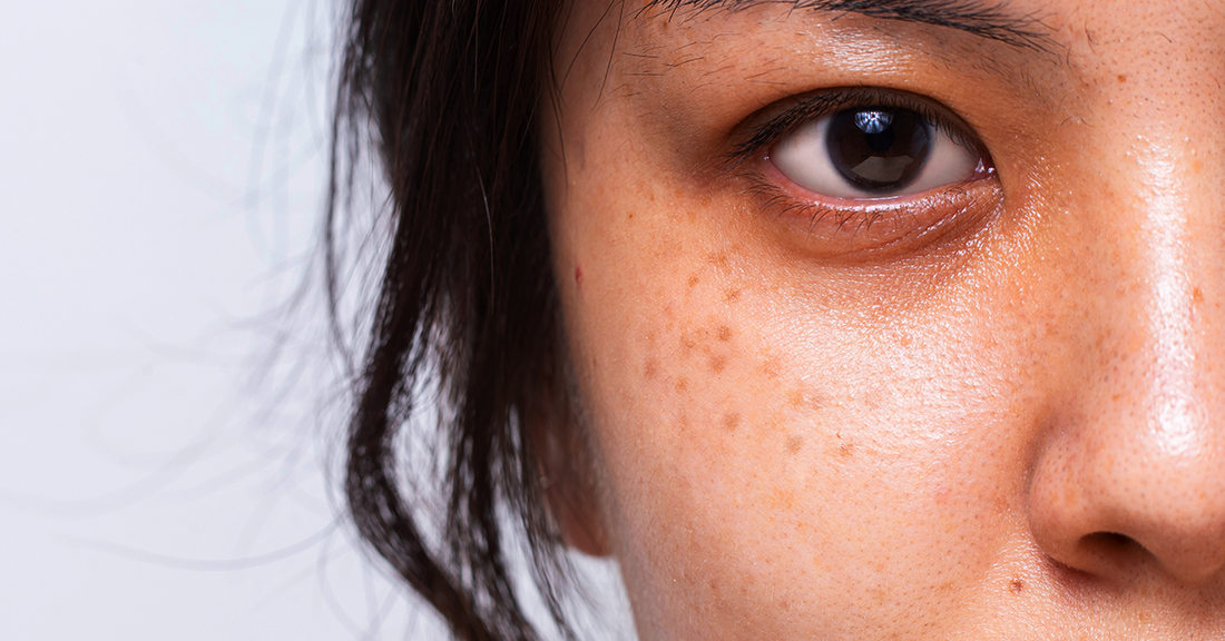 How to Prevent Hyperpigmentation