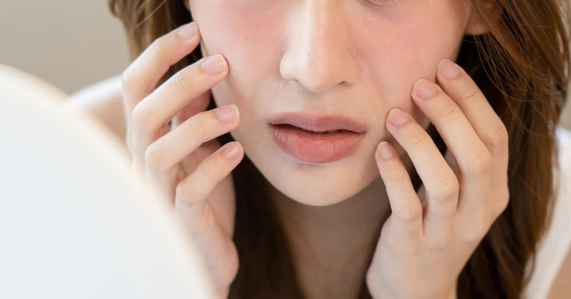 Taking Care of your Acne Prone Skin